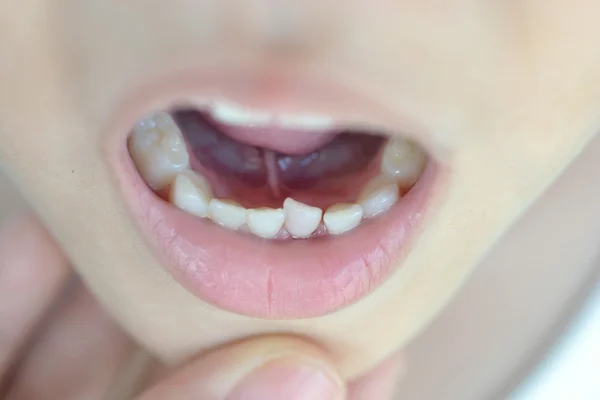 Loss milk tooth — Stock Photo, Image