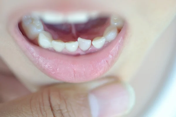 ミルク歯の損失 — ストック写真