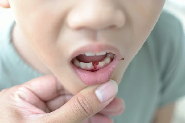 Ztráta mléčný zub — Stock fotografie