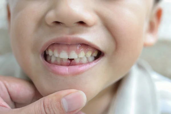 Loss milk tooth — Stock Photo, Image