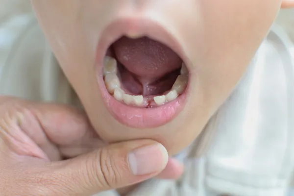 ミルク歯の損失 — ストック写真