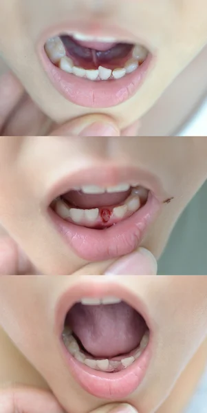 stock image Loss milk tooth series