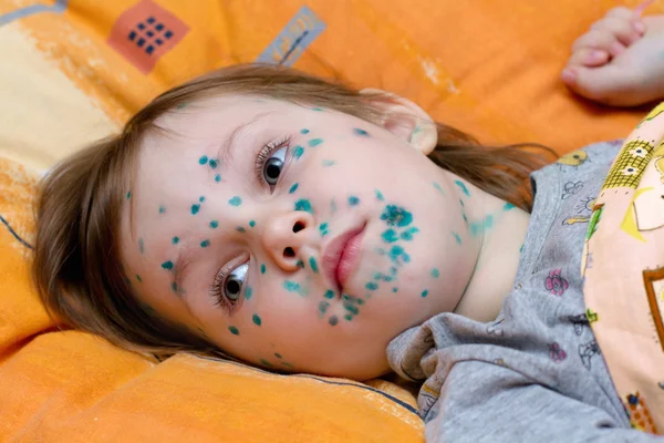 The girl suffers chickenpox Stock Picture