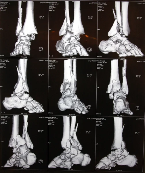 TC do tornozelo direito — Fotografia de Stock