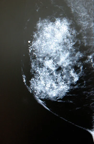 Pełny pole bezpośrednio mammografii piersi — Zdjęcie stockowe