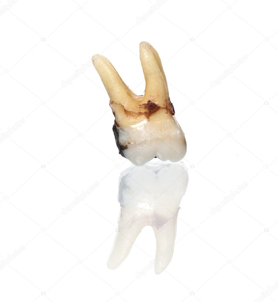 EXTRACTED rotten tooth