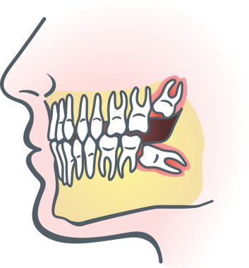 Impacted wisdom tooth