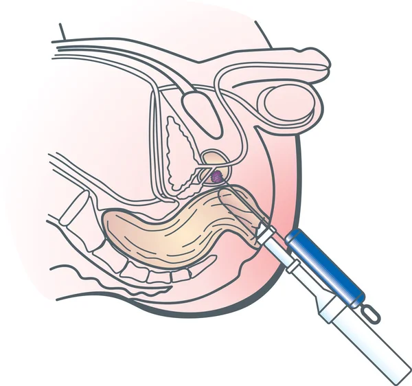 전립선 조직 검사 — 스톡 벡터