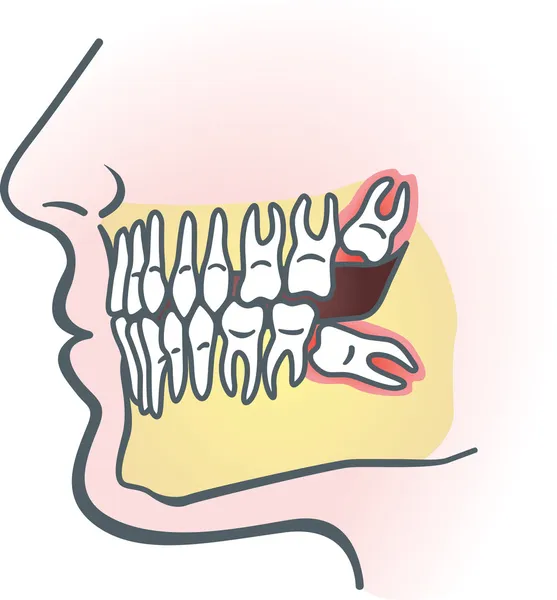 Влияние зуба мудрости — стоковый вектор