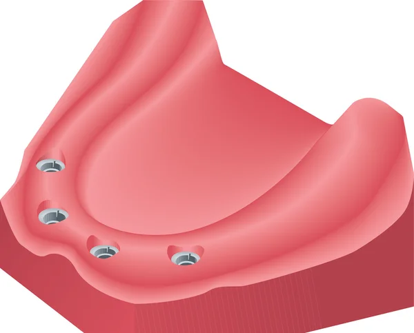 Implante dentário — Vetor de Stock