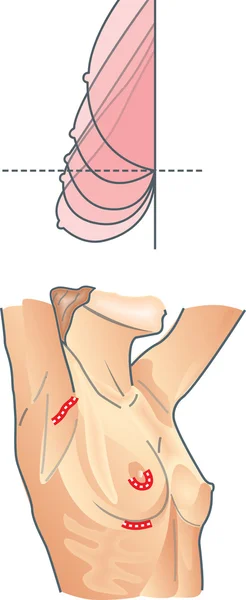 乳房整形手术 — 图库矢量图片
