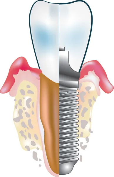 歯のインプラント — ストックベクタ