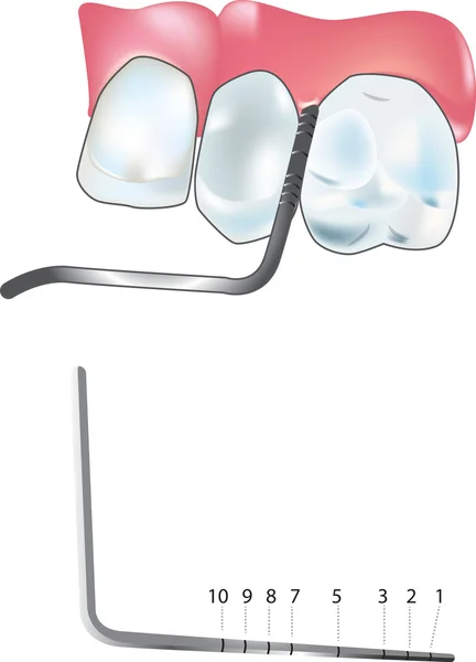 Sonda periodontal — Vetor de Stock