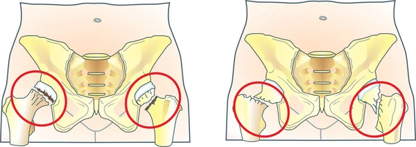 股骨颈骨折 — 图库矢量图片