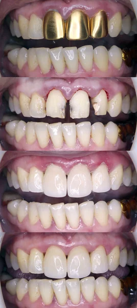 Восстановление зубов Стоковое Изображение