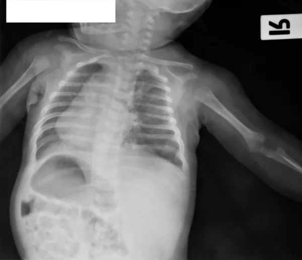 Gromadzenie promieniowania rentgenowskiego — Zdjęcie stockowe