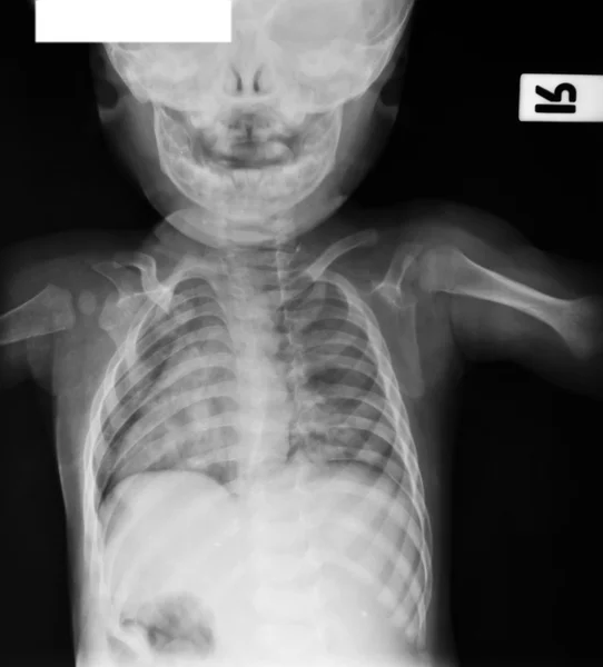 Gromadzenie promieniowania rentgenowskiego — Zdjęcie stockowe