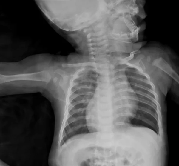 Röntgensugarak gyűjtése — Stock Fotó
