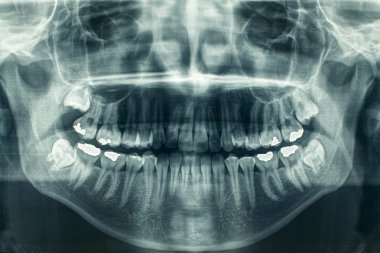 Panoramic dental X-Ray clipart