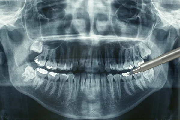 Panoramautsikt över dental xray — Stockfoto