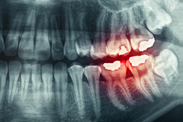 Zahnröntgen — Stockfoto