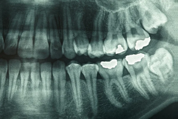 Röntgenfoto van tanden — Stockfoto