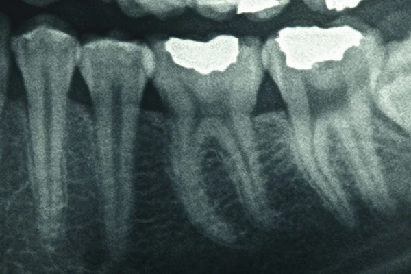 Raio-X dental — Fotografia de Stock