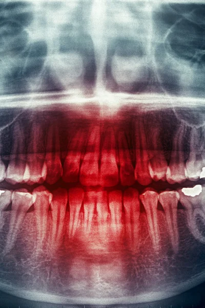Radiografía dental, cráneo de horror — Foto de Stock
