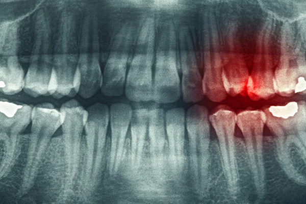 Röntgenfoto van tanden — Stockfoto