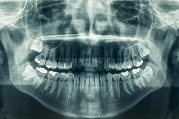 Panoráma fogászati röntgen — Stock Fotó