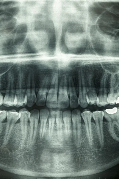 Dentystycznych xray, przerażenie czaszki — Zdjęcie stockowe