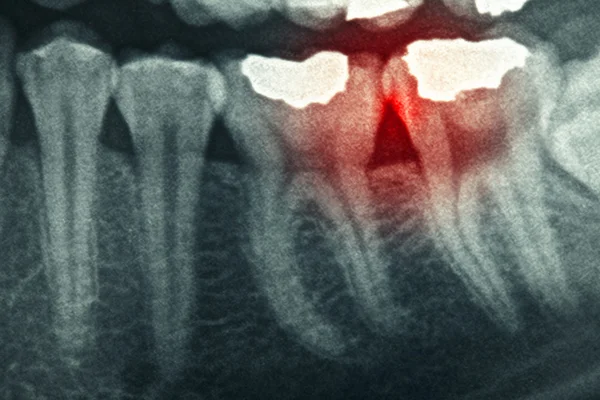 파노라마 치과 엑스레이 — 스톡 사진