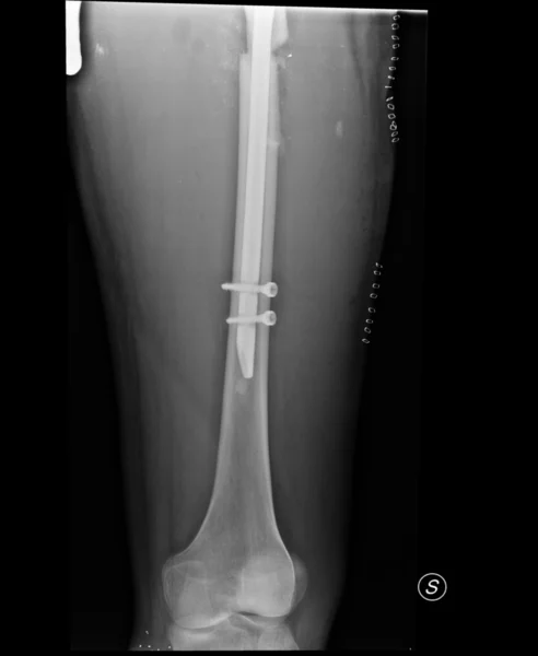부러진된 다리의 엑스레이 — 스톡 사진