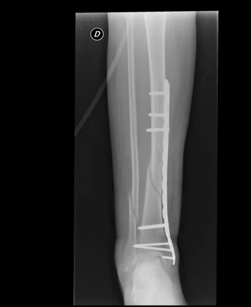 Broken limb — Stock Photo, Image