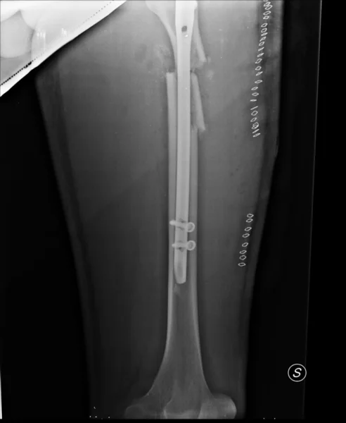 Σπασμένο πόδι — Φωτογραφία Αρχείου