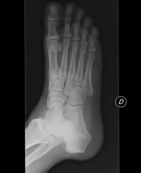 Xray of a broken limb — Stock Photo, Image