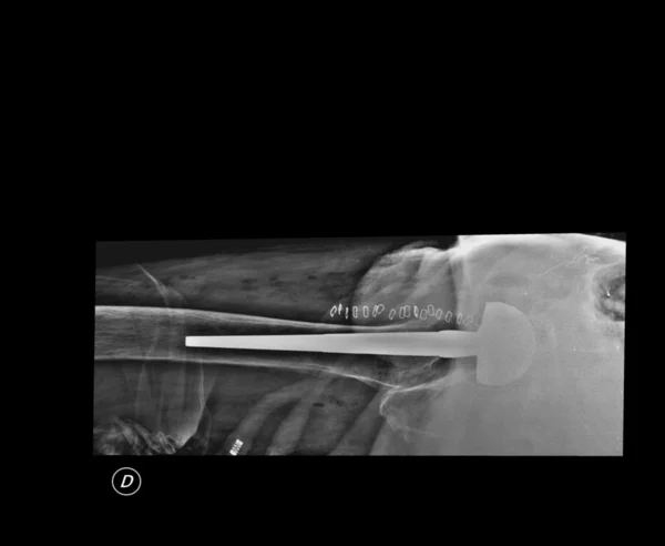 Рентген зламаної кінцівки — стокове фото