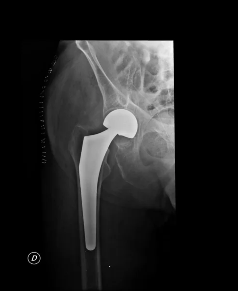 Рентген зламаної кінцівки — стокове фото