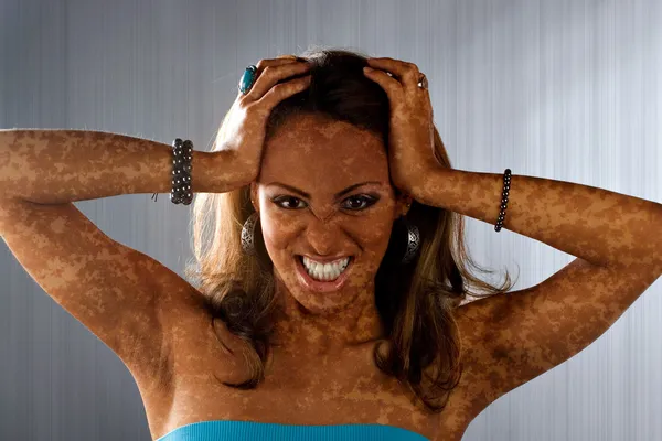Vitiligo Hautzustand — Stockfoto
