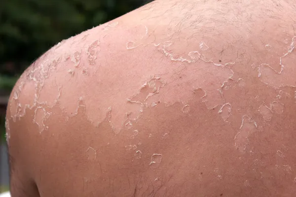 Peeling Sunburned Back — Stock Photo, Image