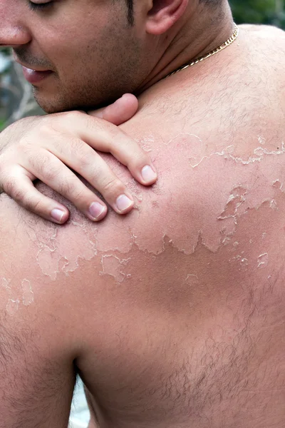 Painful Peeling Sunburn — Stock Photo, Image