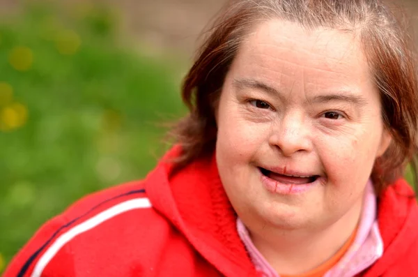 다운 증후군 여자 — 스톡 사진