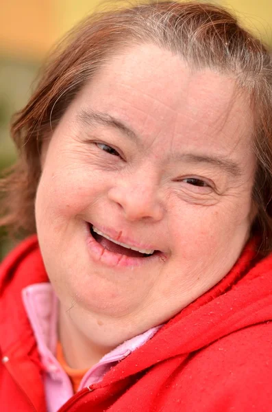 Mulher com síndrome de Down — Fotografia de Stock