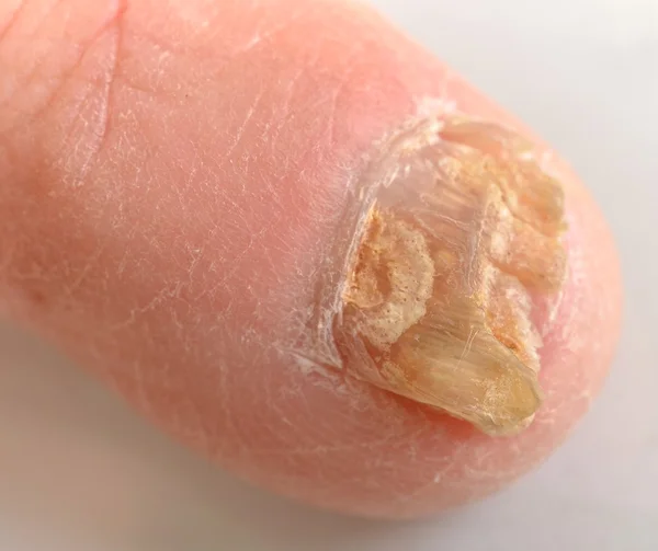 Ένα toenail μύκητας στην αιχμή της λοίμωξης. — Φωτογραφία Αρχείου