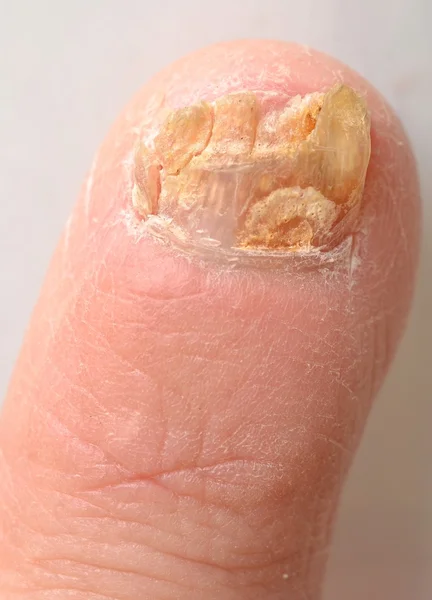 Грибок ногтей на пике инфекции. . — стоковое фото