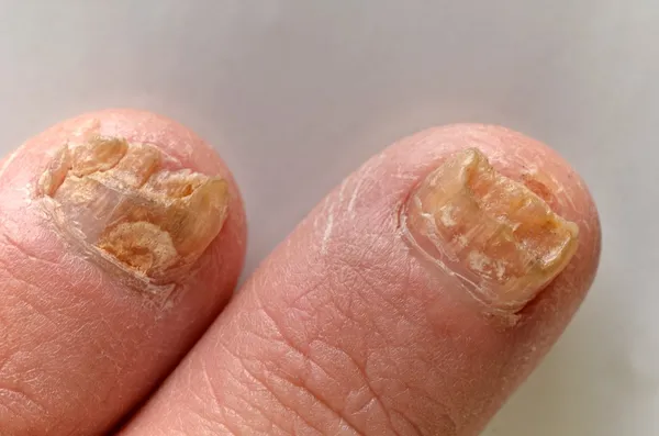 Грибок нігтів на піку інфекції . — стокове фото