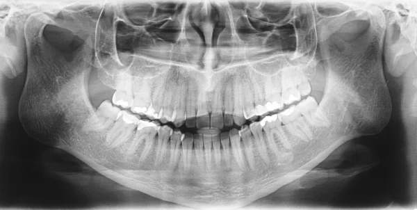 Røntgenskanning av tenner – stockfoto