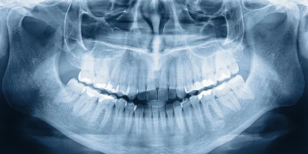 Scansione a raggi X dei denti — Foto Stock