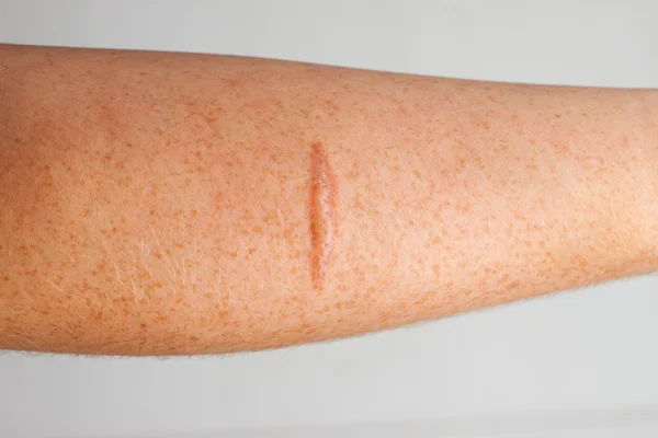 Cicatriz de brazo —  Fotos de Stock