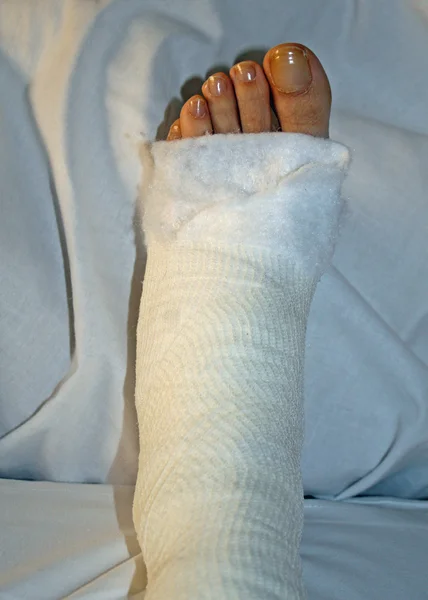 Pé e perna enfaixados após a cirurgia — Fotografia de Stock